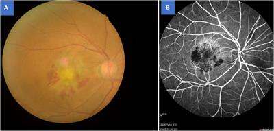 Brain Activity in Age-Related Macular Degeneration Patients From the Perspective of Regional Homogeneity: A Resting-State Functional Magnetic Resonance Imaging Study